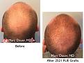 Click image for larger version

Name:	Hair Transplant Slides copy17.005.jpg
Views:	9227
Size:	15.5 KB
ID:	475586