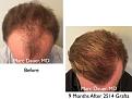 Click image for larger version

Name:	Hair Transplant Slides copy20.004.jpg
Views:	246
Size:	15.7 KB
ID:	475857