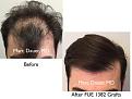 Click image for larger version

Name:	Hair Transplant Slides copy26.001.jpg
Views:	317
Size:	14.2 KB
ID:	475905