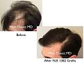 Click image for larger version

Name:	Hair Transplant Slides copy26.002.jpg
Views:	305
Size:	13.2 KB
ID:	475907