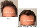 Click image for larger version

Name:	Hair Transplant Slides copy25.001.jpg
Views:	316
Size:	13.7 KB
ID:	477933