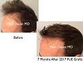Click image for larger version

Name:	Hair Transplant Slides copy25.002.jpg
Views:	275
Size:	13.4 KB
ID:	477934