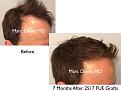 Click image for larger version

Name:	Hair Transplant Slides copy25.003.jpg
Views:	274
Size:	13.9 KB
ID:	477935