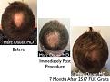 Click image for larger version

Name:	Hair Transplant Slides copy25.005.jpg
Views:	300
Size:	17.1 KB
ID:	477937