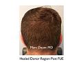 Click image for larger version

Name:	Hair Transplant Slides copy25.006.jpg
Views:	272
Size:	12.2 KB
ID:	477938