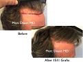 Click image for larger version

Name:	Hair Transplant Slides copy46.003.jpg
Views:	327
Size:	15.8 KB
ID:	477999