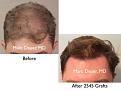 Click image for larger version

Name:	Hair Transplant Slides copy50.001.jpg
Views:	254
Size:	12.5 KB
ID:	478191