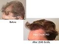 Click image for larger version

Name:	Hair Transplant Slides copy50.002.jpg
Views:	240
Size:	12.1 KB
ID:	478192