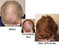 Click image for larger version

Name:	Hair Transplant Slides copy50.004.jpg
Views:	249
Size:	15.4 KB
ID:	478194