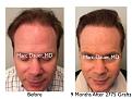 Click image for larger version

Name:	Hair Transplant Slides copy50.007.jpg
Views:	292
Size:	16.1 KB
ID:	478360