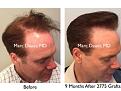 Click image for larger version

Name:	Hair Transplant Slides copy50.008.jpg
Views:	296
Size:	16.9 KB
ID:	478361