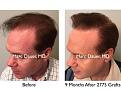Click image for larger version

Name:	Hair Transplant Slides copy50.006.jpg
Views:	278
Size:	16.5 KB
ID:	478362