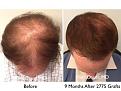 Click image for larger version

Name:	Hair Transplant Slides copy50.009.jpg
Views:	290
Size:	16.8 KB
ID:	478363