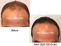 Click image for larger version

Name:	Hair Transplant Slides copy60.001.jpg
Views:	386
Size:	12.3 KB
ID:	478468