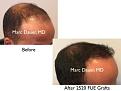 Click image for larger version

Name:	Hair Transplant Slides copy60.003.jpg
Views:	356
Size:	12.0 KB
ID:	478469
