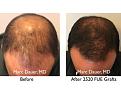 Click image for larger version

Name:	Hair Transplant Slides copy60.004.jpg
Views:	403
Size:	14.7 KB
ID:	478471