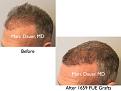 Click image for larger version

Name:	Hair Transplant Slides copy13.002.jpg
Views:	318
Size:	12.7 KB
ID:	478766