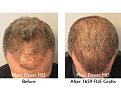 Click image for larger version

Name:	Hair Transplant Slides copy13.004.jpg
Views:	350
Size:	17.3 KB
ID:	478768