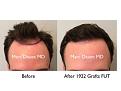 Click image for larger version

Name:	Hair Transplant Slides copy229.001.jpg
Views:	382
Size:	11.9 KB
ID:	479458