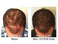 Click image for larger version

Name:	Hair Transplant Slides copy1111.002.jpg
Views:	290
Size:	16.7 KB
ID:	479844