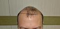 Click image for larger version

Name:	Best-FUE-hair-transplant-India (1).jpg
Views:	300
Size:	90.7 KB
ID:	483341
