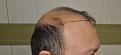 Click image for larger version

Name:	Best-FUE-hair-transplant-India (3).jpg
Views:	308
Size:	93.1 KB
ID:	483342