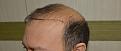 Click image for larger version

Name:	Best-FUE-hair-transplant-India (2).jpg
Views:	342
Size:	94.3 KB
ID:	483343