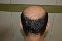 Click image for larger version

Name:	Best-FUE-hair-transplant-India (4).jpg
Views:	374
Size:	90.7 KB
ID:	483344