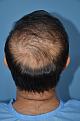 Click image for larger version

Name:	Best-FUE-hair-transplant-India (8).jpg
Views:	947
Size:	91.3 KB
ID:	483348
