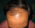 Click image for larger version

Name:	Hair Transplant Images.jpg
Views:	199
Size:	91.0 KB
ID:	485746