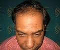 Click image for larger version

Name:	Hair Transplant Days.jpg
Views:	188
Size:	82.7 KB
ID:	485747