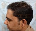 Click image for larger version

Name:	Hair Transplant Side Effect.jpg
Views:	202
Size:	84.4 KB
ID:	485748