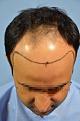 Click image for larger version

Name:	darling buds clinic hair transplant esult at 6 months in Indiia (3).jpg
Views:	210
Size:	8.3 KB
ID:	494495