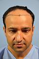 Click image for larger version

Name:	darling buds clinic hair transplant esult at 6 months in Indiia (4).jpg
Views:	207
Size:	8.1 KB
ID:	494496
