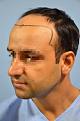 Click image for larger version

Name:	darling buds clinic hair transplant esult at 6 months in Indiia (5).jpg
Views:	184
Size:	8.3 KB
ID:	494497