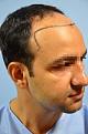 Click image for larger version

Name:	darling buds clinic hair transplant esult at 6 months in Indiia (9).jpg
Views:	184
Size:	8.7 KB
ID:	494498