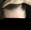 Click image for larger version

Name:	Front hairline 2.jpg
Views:	141
Size:	58.0 KB
ID:	495281