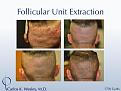 An example of short-term donor area recovery after follicular unit extraction (FUE) with Dr. Carlos K. Wesley (NYC).

A video montage of many more patients' FUE donor recoveries may be viewed at https://vimeo.com/70354892